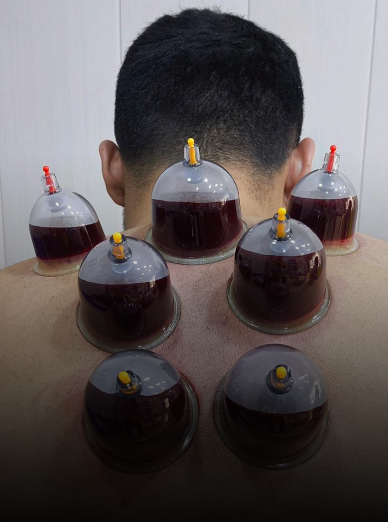 Hijama-(Cupping-Therapy)-image-1